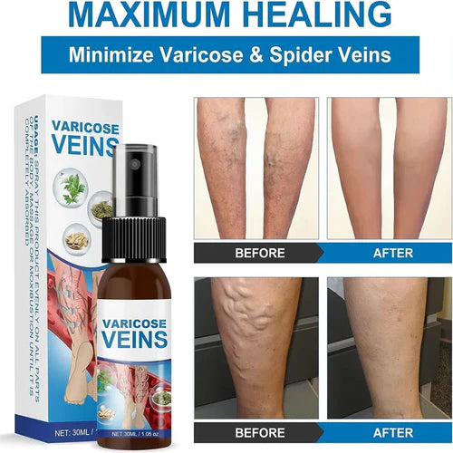 Last Day Of Discount 🔥 Varicose Veins Spray